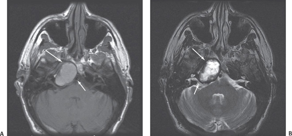 Cholesterol Granuloma Of The Petrous Apex Radiology Key