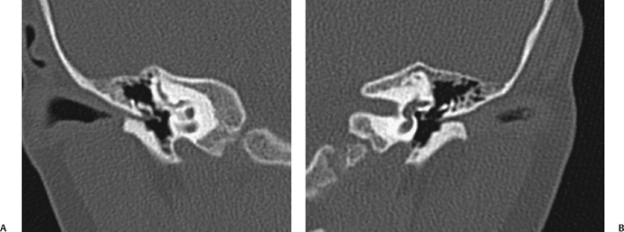 External Auditory Canal Stenosis Ct