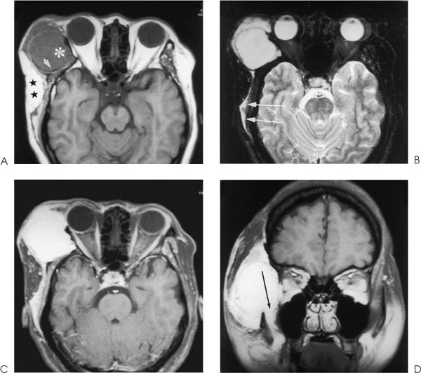 Hemangiosarcoma Radiology Key Free Nude Porn Photos