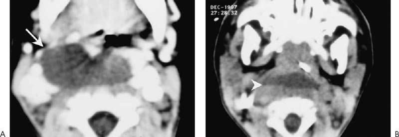 Lymphatic Malformations Radiology Key