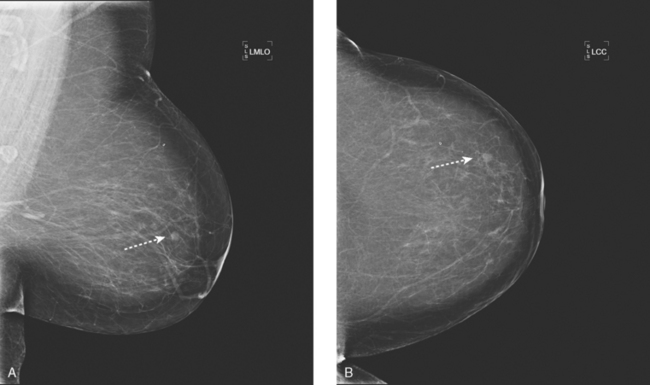 Outer Breast Mass 57