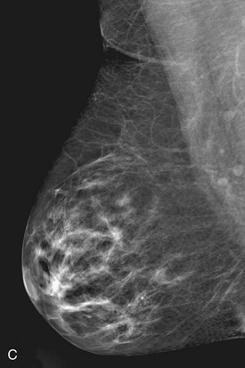 Mammogram Interpretation | Radiology Key