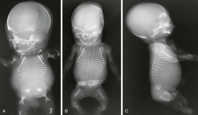 Skeletal Dysplasias and Selected Chromosomal Disorders | Radiology Key