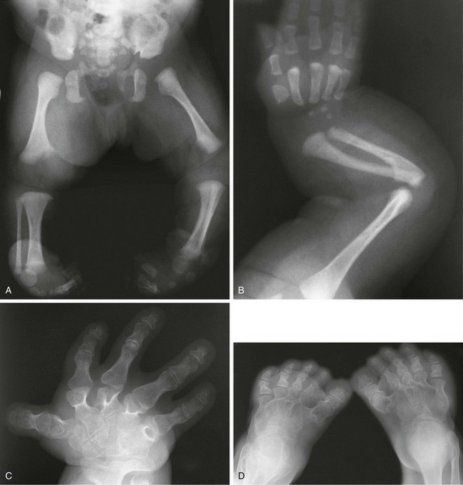 Skeletal Dysplasias And Selected Chromosomal Disorders | Radiology Key