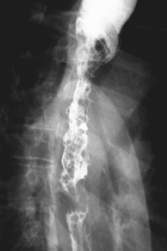 esophageal varices x ray