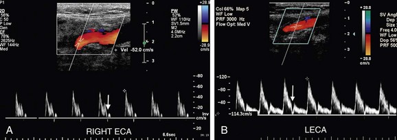 Ultrasound Evaluation of the Carotid Arteries | Radiology Key
