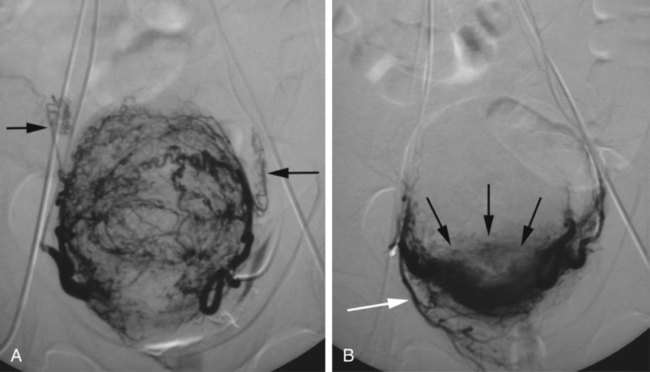 Uterine Fibroid Embolization Radiology Key