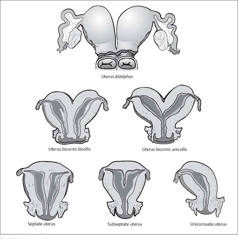 The Uterus and Vagina | Radiology Key