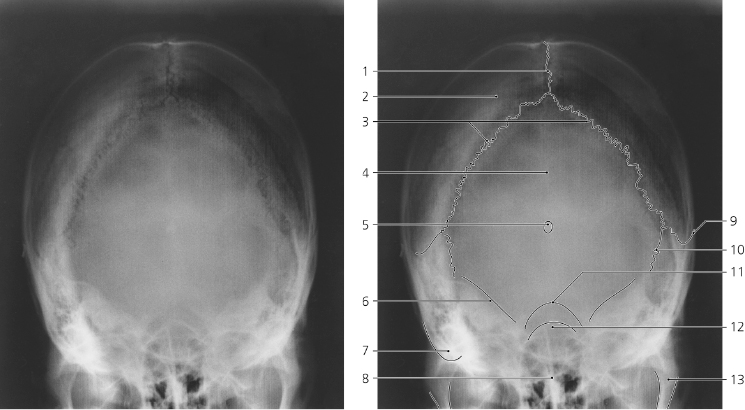 Skull | Radiology Key