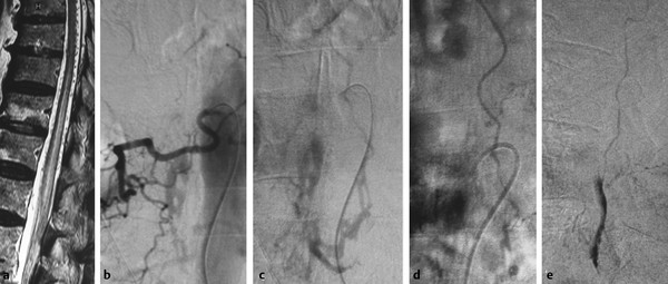 The Spinal Cord Veins Radiology Key