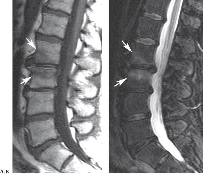 mid lumbar spine