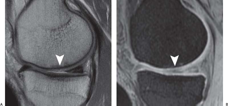 Articular Cartilage | Radiology Key