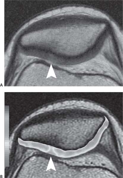 Articular Cartilage | Radiology Key