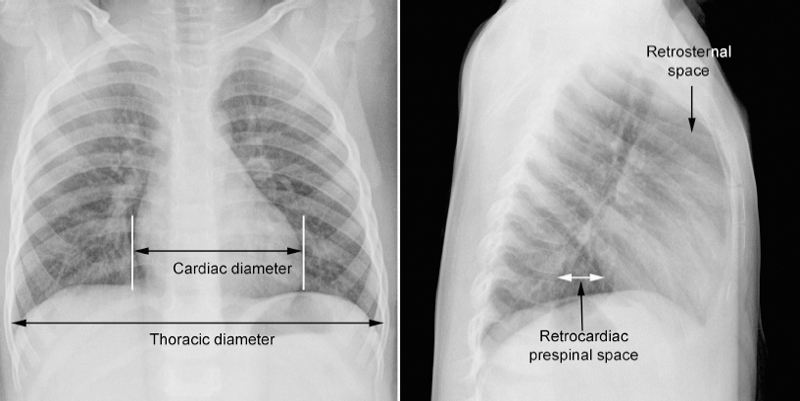 Heart Size Overall Configuration And Specific Chamber Enlargement 