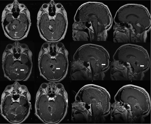 Skull Base Surgery And Intraoperative Magnetic Resonance Imaging