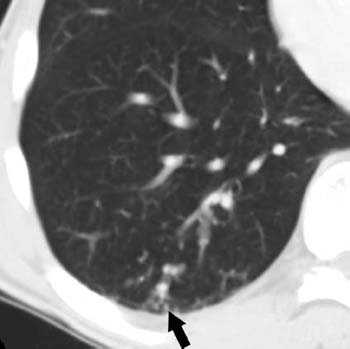 Embolism Radiology Key