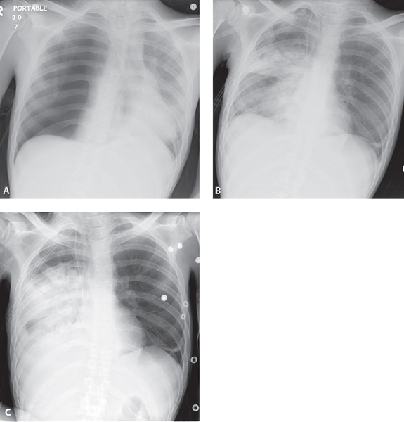 Re Expansion Pulmonary Edema Radiology Key