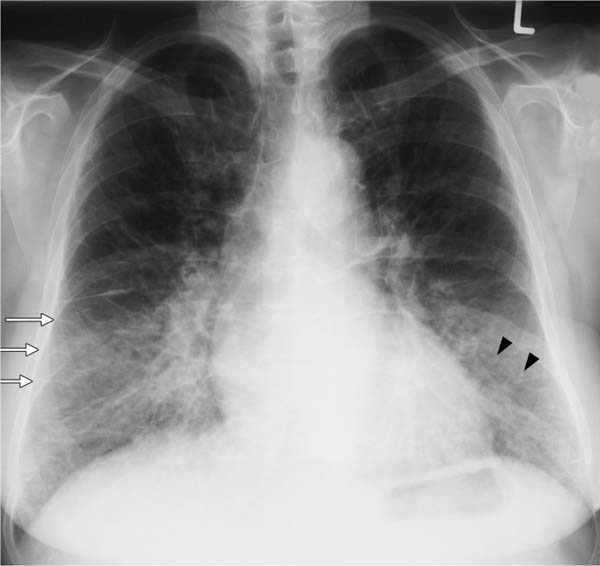Chest X Ray Findings Pulmonary Fibrosis At Barbara Padgett Blog