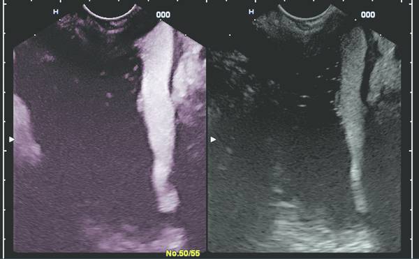 Extravascular Use Of Ultrasound Contrast Agents Radiology Key