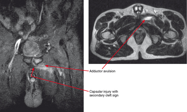 Imaging Of The Hip And Pelvis Radiology Key