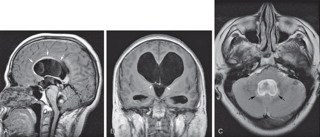 Classical Concepts Of Hydrocephalus Radiology Key