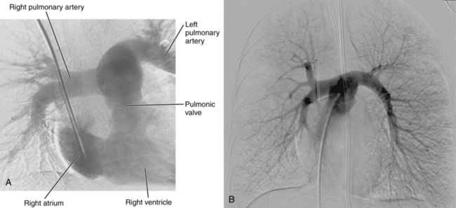 Pulmonary and bronchial arteries | Radiology Key