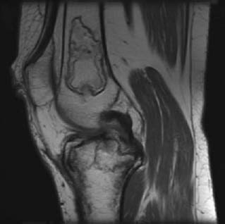 78 Medullary Bone Infarct | Radiology Key