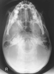 Skull, Facial Bones, and Paranasal Sinuses | Radiology Key