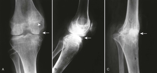 TB of knee joint - radRounds Radiology Network