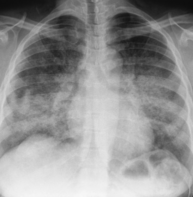 Airspace Disease Radiology Key