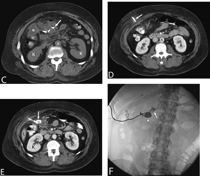 Percutaneous Drainage Of Fluid Collection Radiology Key