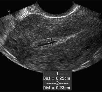 Endometrial Measurement In The Presence Of Fluid Medical Ultrasound Ultrasound Sonography Obstetric Ultrasound