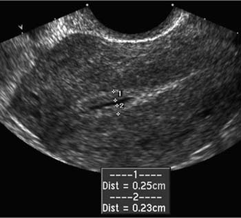 Pin On Ob Gyn Ultrasound 101 Mod 2