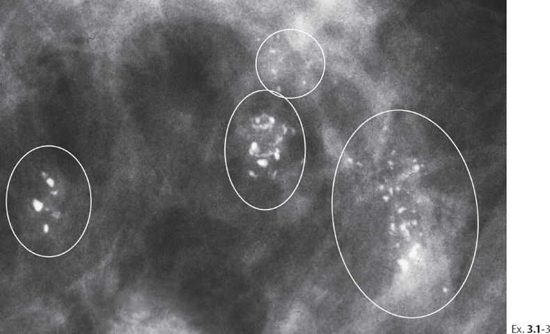 multiple-clusters-of-crushed-stone-like-calcifications-on-the-mammogram