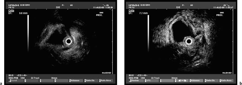 Endoscopic Ultrasound Of The Colon Radiology Key