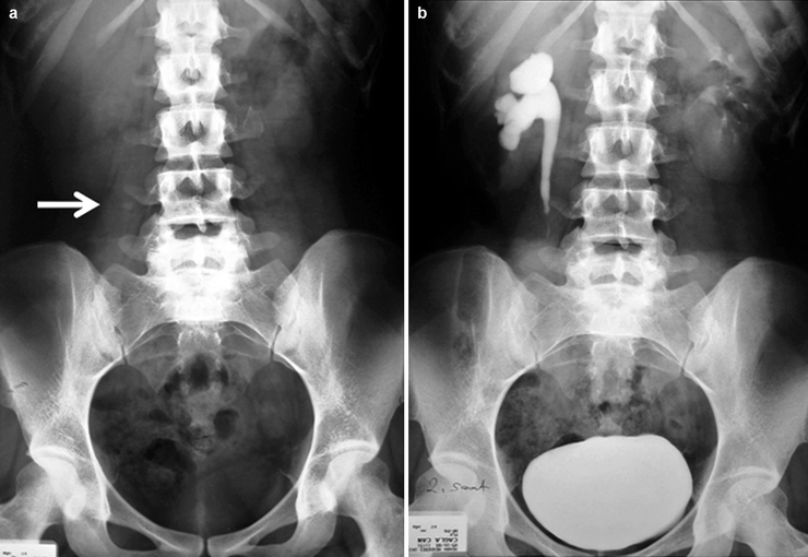 Non Obstructive Right Renal Calculus Meaning In Kannada