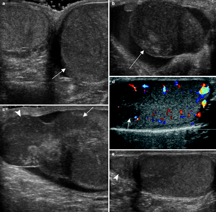 Testicular Cancer Imaging Radiology Key