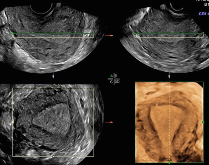 Ultrasound Of The Uterus Showing Normal Endometrium And Myometrium