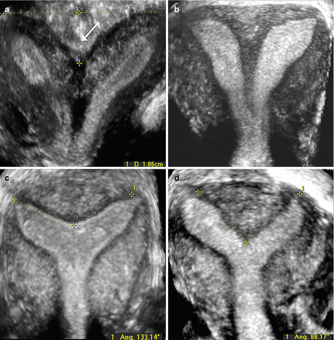 Congenital Uterine Anomalies | Radiology Key
