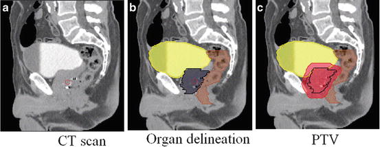 segmentation-of-pelvic-structures-from-ct-scans-for-planning-in