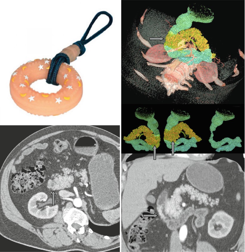 Pancreas Radiology Key