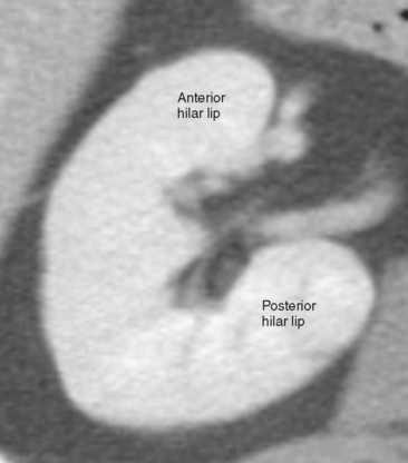 Kidneys | Radiology Key