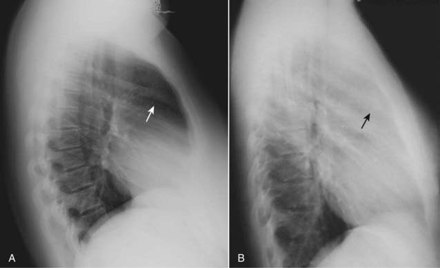 Recognizing Normal Chest Anatomy and a Technically Adequate Chest