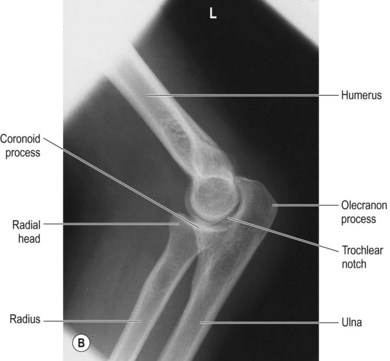 Forearm, elbow and humerus | Radiology Key