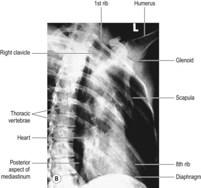 Thoracic skeleton | Radiology Key