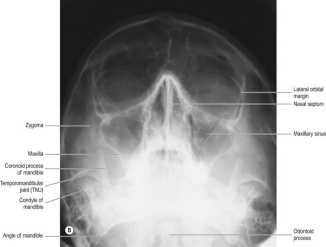 Facial bones | Radiology Key