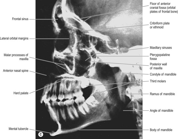 Facial bones | Radiology Key
