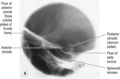 skull projections sella turcica lateral specialised radiology figure radiologykey