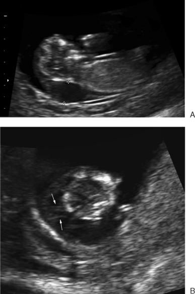 First Trimester Screening For Aneuploidy Radiology Key