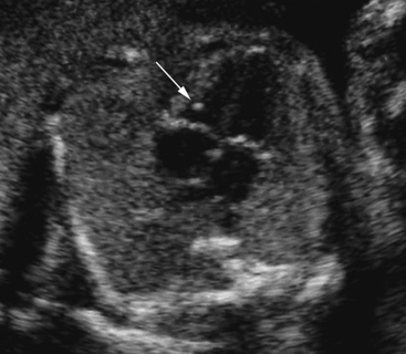 echogenic focus intracardiac heart ventricle arrow seen figure right radiologykey